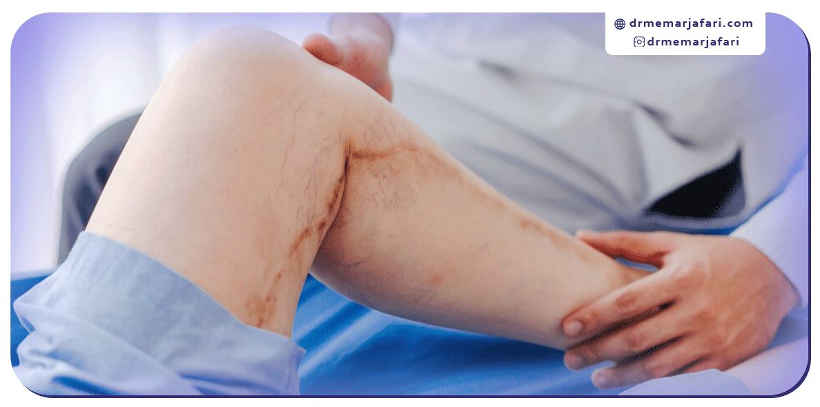 عوارض عدم درمان واریس پا