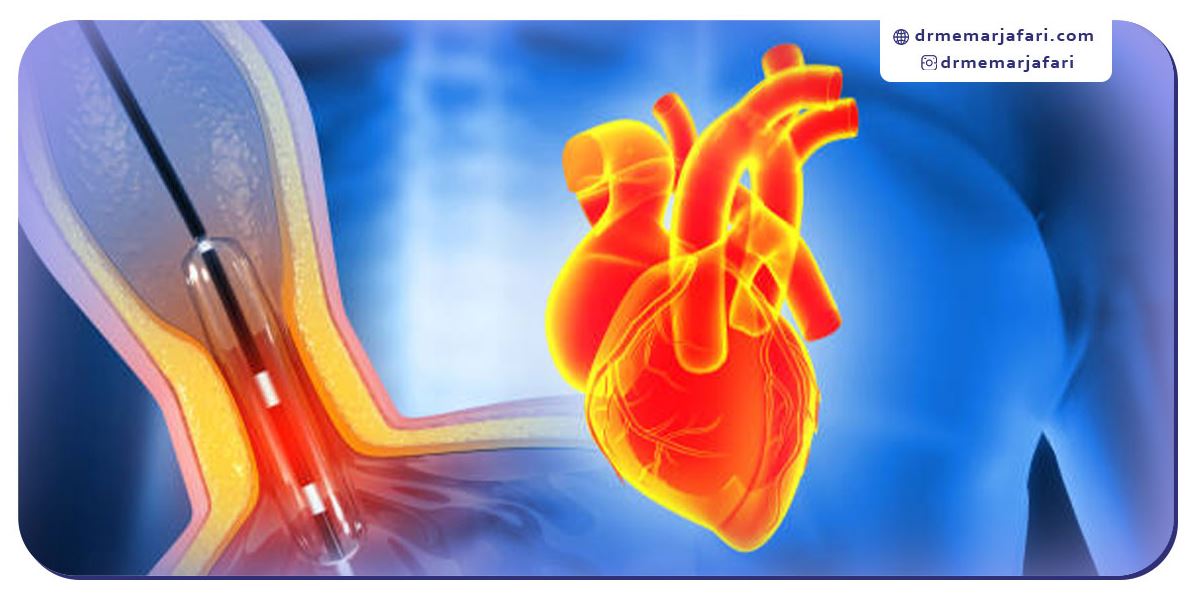 عوارض بعد از آنژیوگرافی قلب