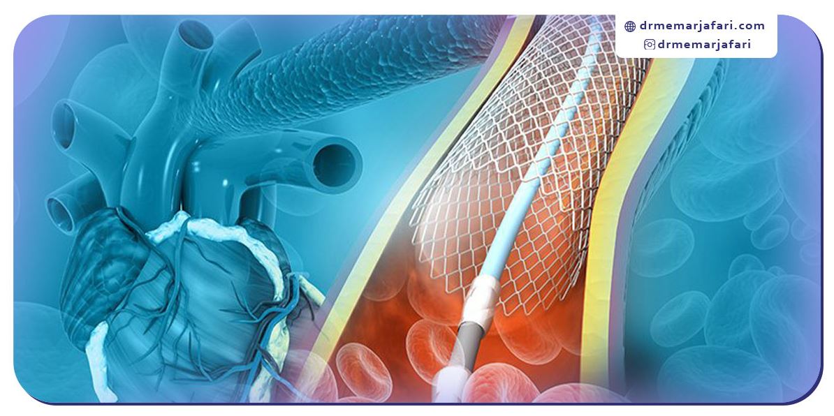 چه کسانی به آنژیوگرافی قلب نیاز دارند؟