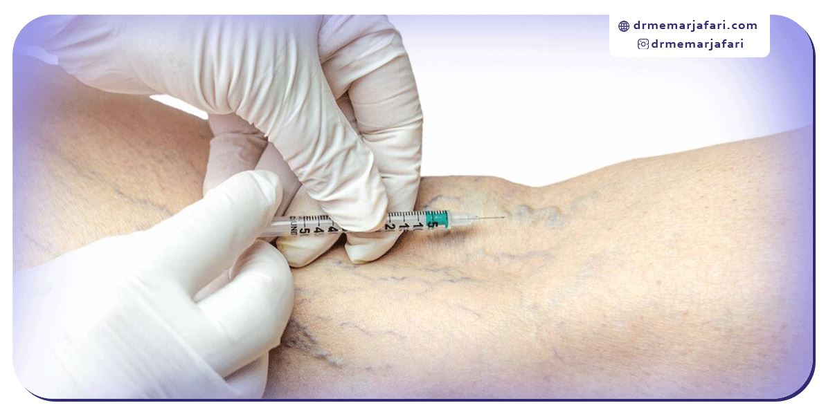 چگونه واریس پا را درمان کنیم؟