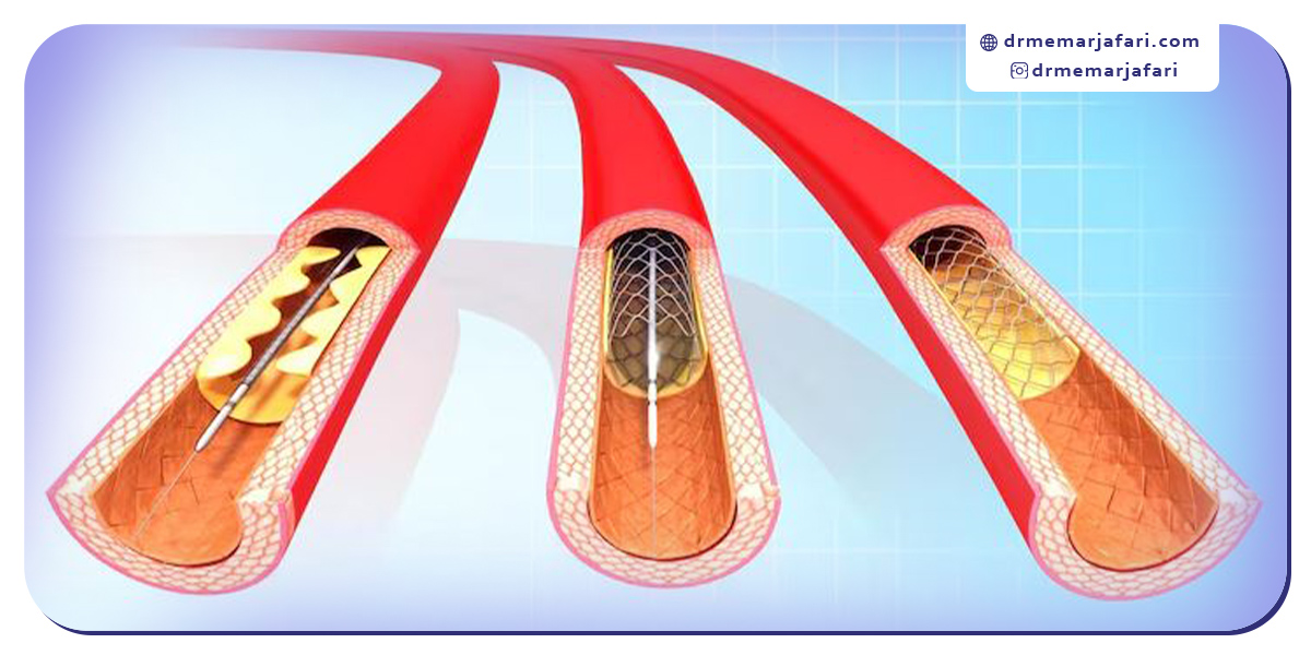مراحل انجام آنژیوپلاستی کاروتید