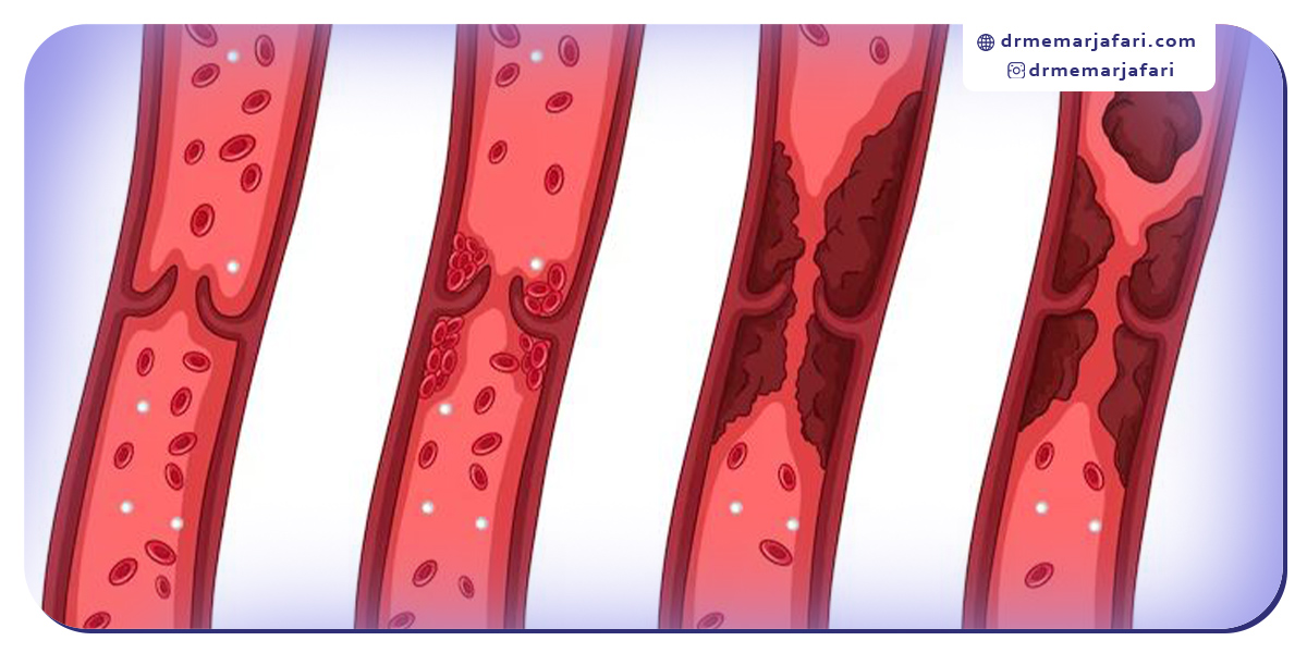 مزایای آنژیوپلاستی کاروتید