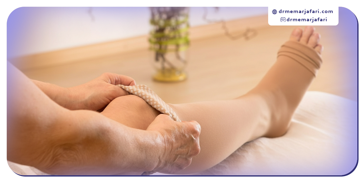 درمان خانگی واریس در مراحل خفیف