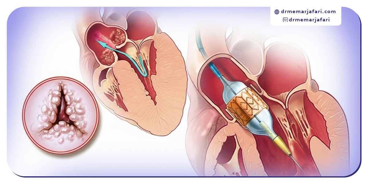 نحوه انجام عمل تاوی (TAVI) قلب